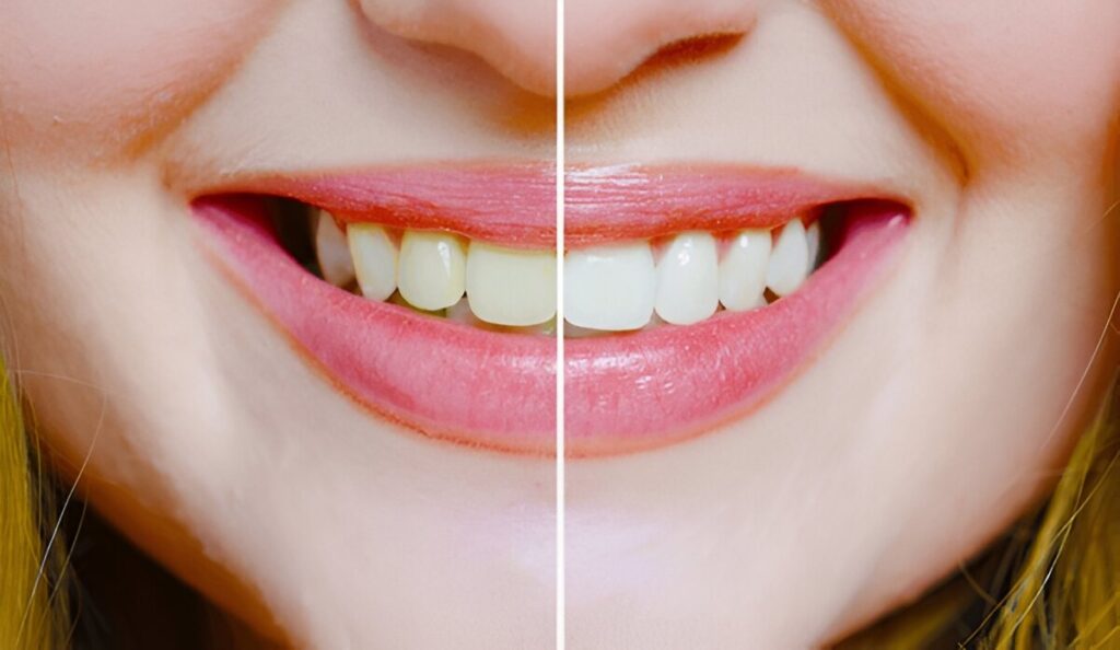 Teeth Cleaning Edmonton